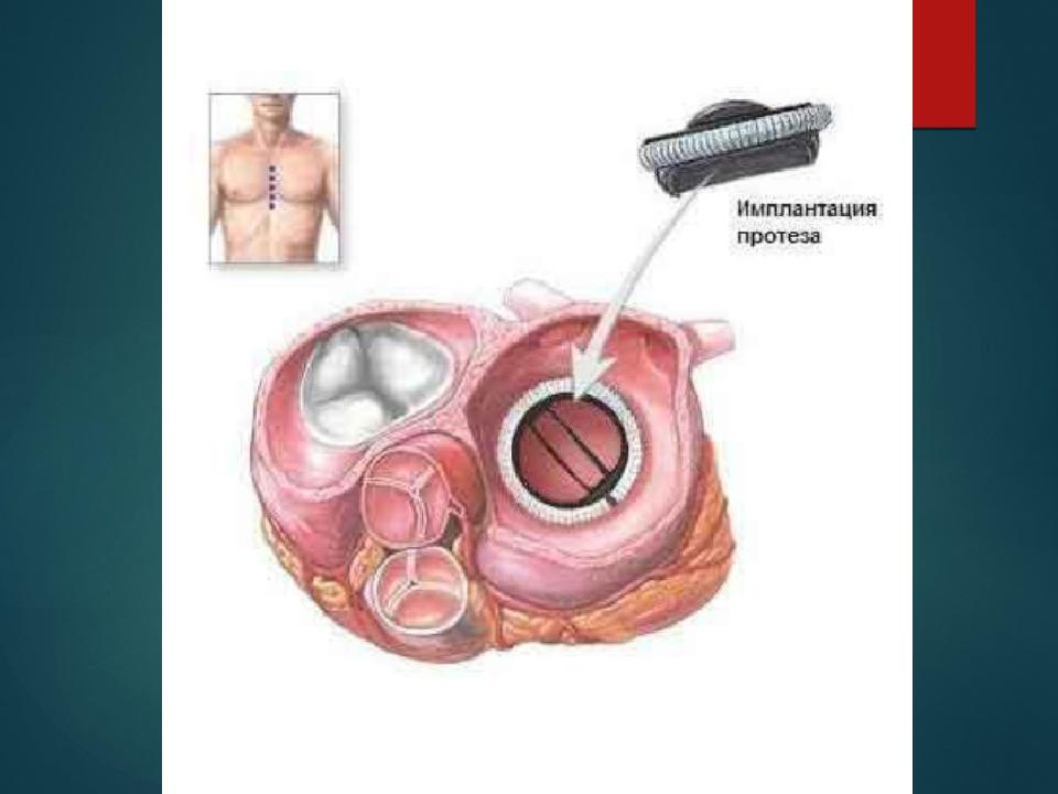 Протезирование клапана. Аортальный клапан и митральный клапан. Механический протез митрального клапана. Механический протез аортального клапана. Протезирование аортального клапана операция.