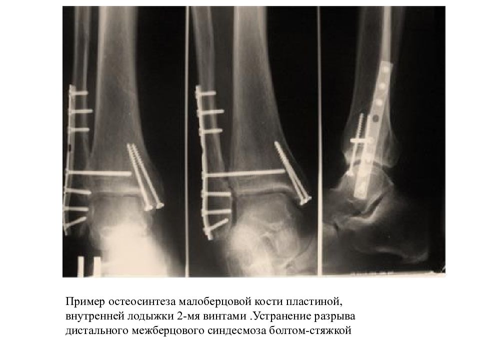 Презентация перелом костей голени