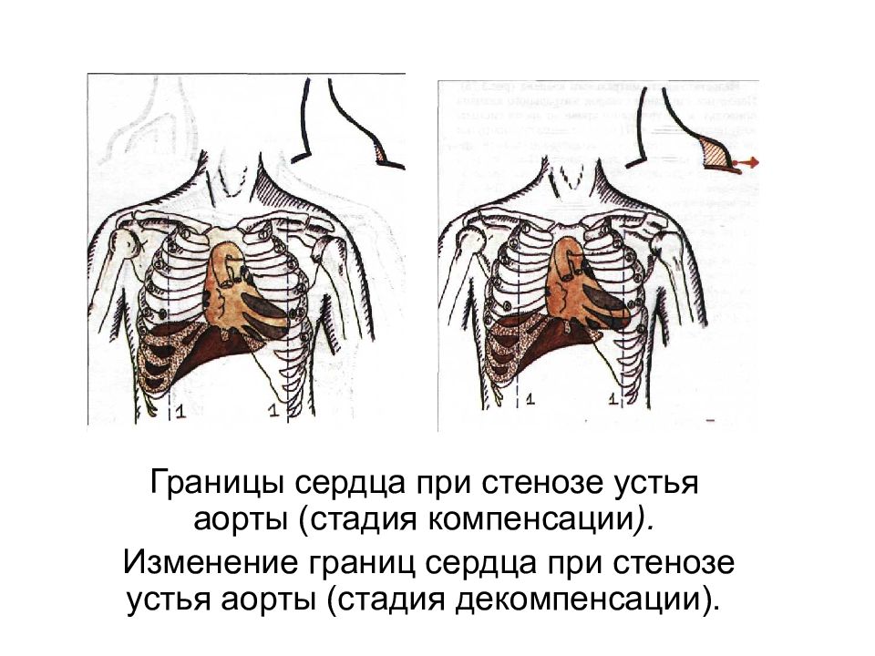 Границы сердца. Границы сердца при митральном стенозе. Изменение границ сердца. Границы сердца при ревматической лихорадке. . При митральном стенозе изменяются границы сердца:.