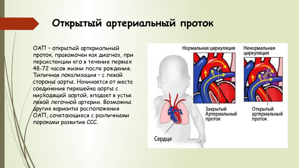 Оап у новорожденных. Врожденный порок сердца открытый артериальный проток. Аортальный проток у новорожденных. Открытого артериального протока.