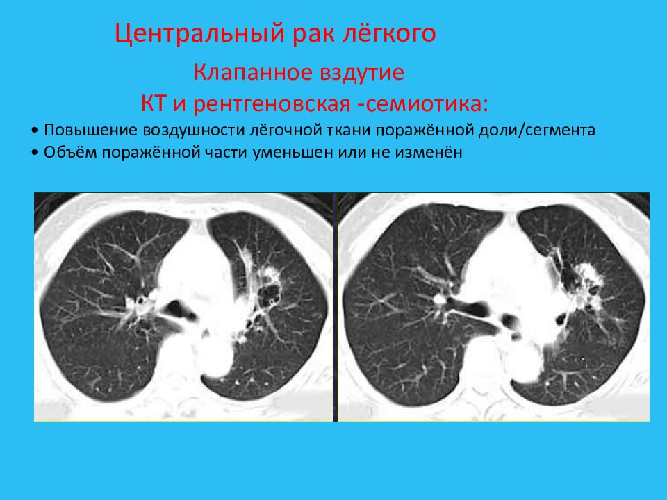 Центральное легкое. Клапанное вздутие легочной ткани. Повышение воздушности легочной ткани кт. Клапанное вздутие легочной ткани на кт. Повышение воздушность легкого НАСКТ.