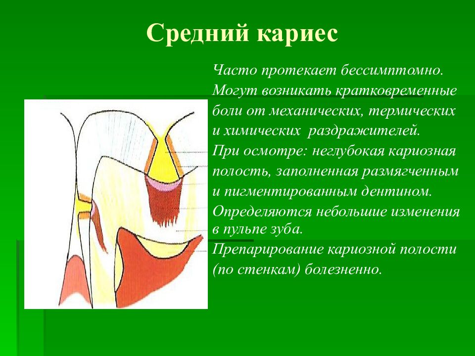 Образовавшихся полостей. Средний кариес зондирование. Боль при среднем кариесе. Зондирование при среднем кариесе.