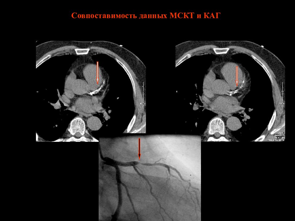 Атеросклероз мрт. Кальциноз коронарных артерий на кт. Кт сердца и коронарных сосудов. Многослойная спиральная компьютерная томография (МСКТ). Мультиспиральная кт коронарных сосудов.