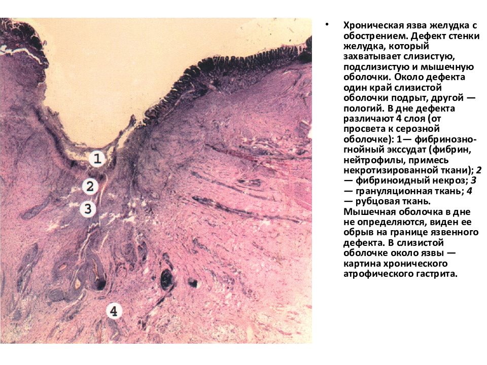 Хроническая язва желудка микропрепарат рисунок