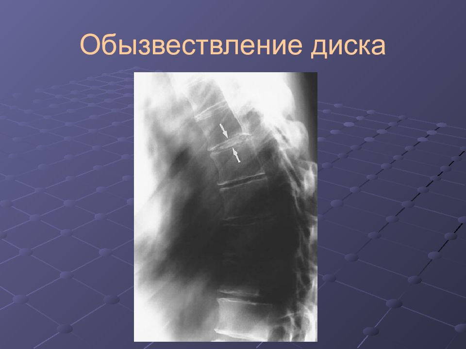 Обызвествление это. Обызвествление межпозвонковых дисков рентген. Обызвествление диска позвоночника. Обыщвествление позвоночного лиска. Обызвествление межпозвонкового диска на кт.