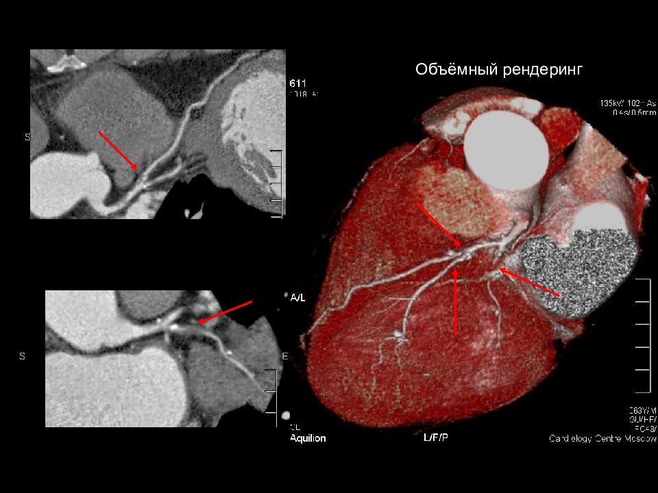 Кт сердца. Коронарография стеноз. Мультиспиральная кт коронарных артерий. Проксимальный стеноз ПНА. МСКТ ангиография коронарных артерий.