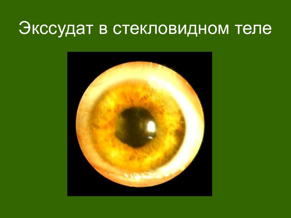 Экссудат это. Экссудат в стекловидном теле. Патология стекловидного тела. Патологии стекловидного тела презентации. Воспалительный выпот в стекловидное тело.