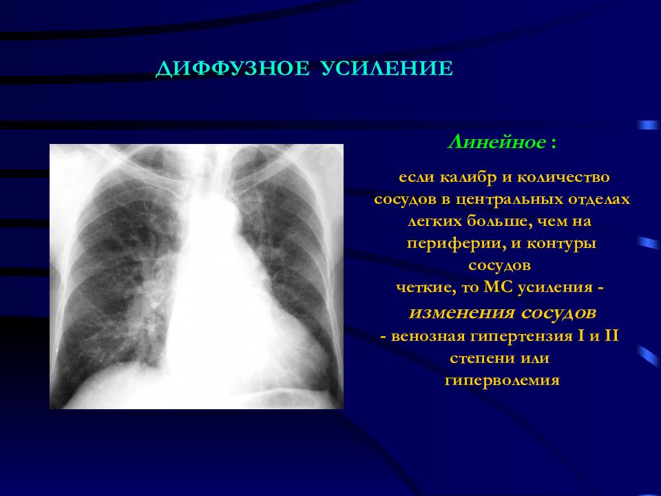 Усилен диффузно легочный рисунок что это значит у взрослого на рентгене