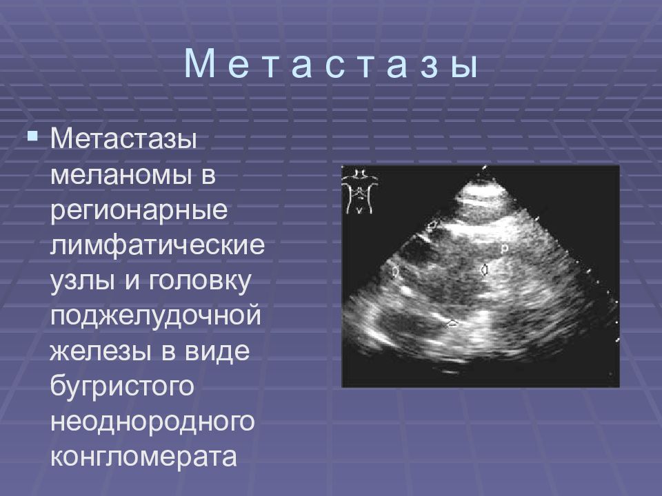 Метастатические лимфоузлы. УЗИ протокол метастазов в лимфоузлах. Метастазы в лимфоузлы на УЗИ. Метастатические лимфоузлы на УЗИ. УЗИ поджелудочной железы.