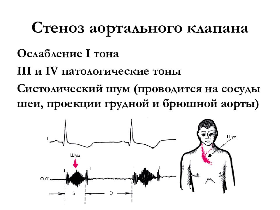 Ослабленные тоны сердца. Систолический шум на аорте. Систолический шум над аортальным клапаном. Аортальный стеноз систолический шум. Патологические тоны сердца.