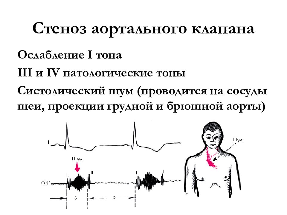 Ослабленные тоны сердца