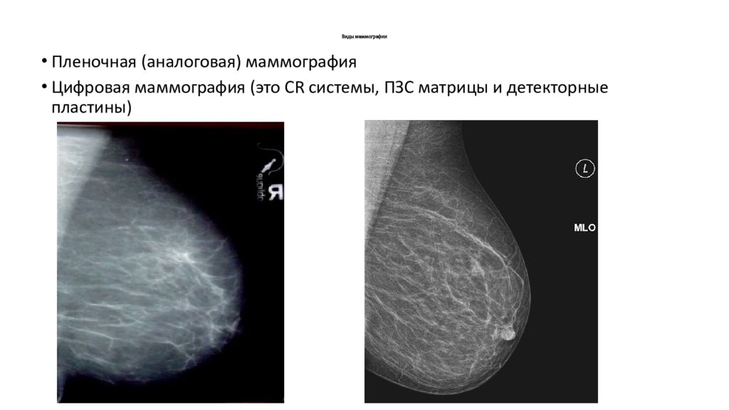 Маммография ответы. Фиброаденома молочной железы маммография заключение. Рентген молочных желез маммография. Пленочная маммография.