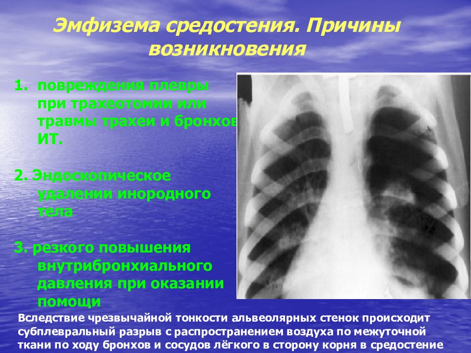 Подкожная эмфизема. Медиастинальная эмфизема рентген. Медиастинальная эмфизема кт. Эмфизема средостения рентген. Спонтанная эмфизема средостения.