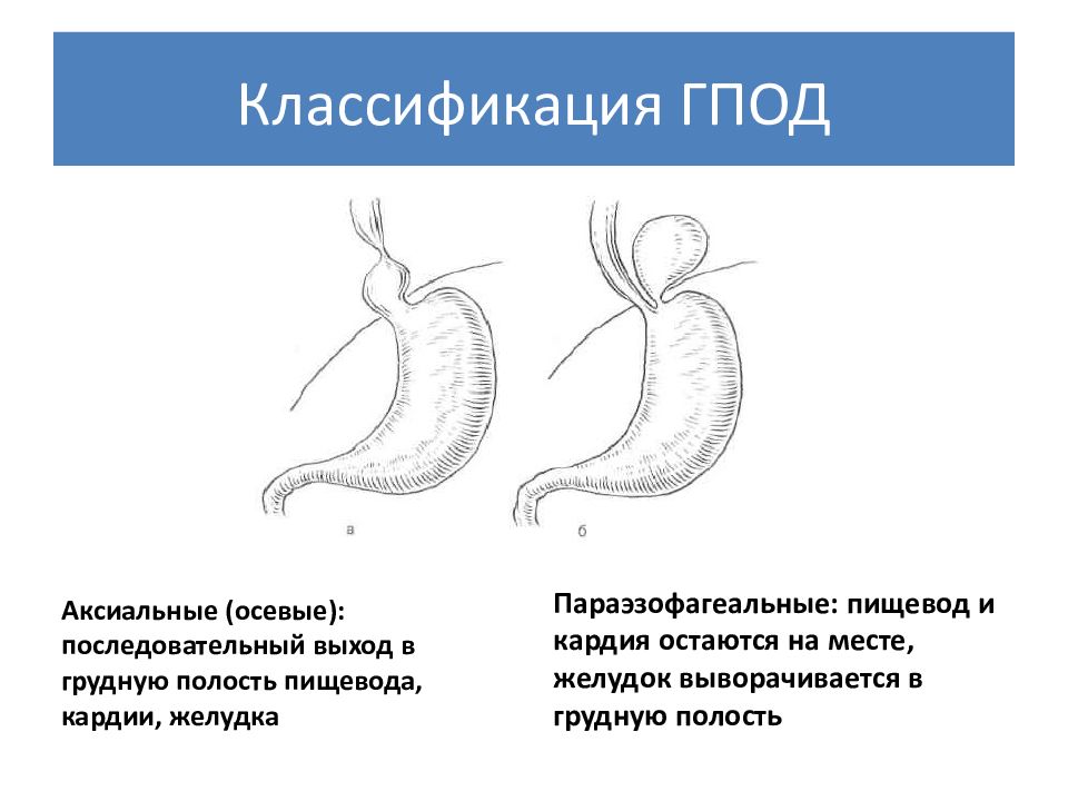 Скользящая грыжа