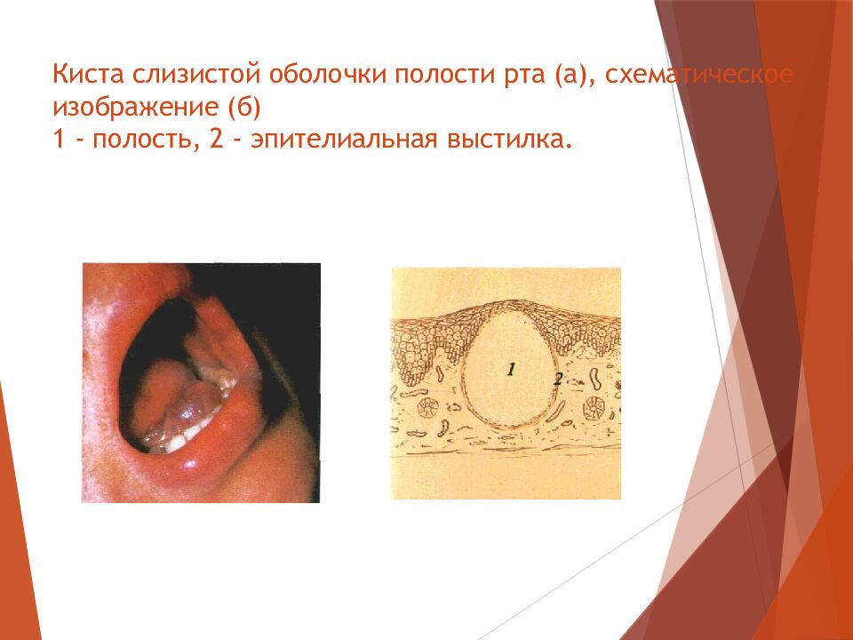 Киста слизистой оболочки полости рта (а), схематическое изображение (б) 1 - полость, 2 - эпителиальная выстилка.