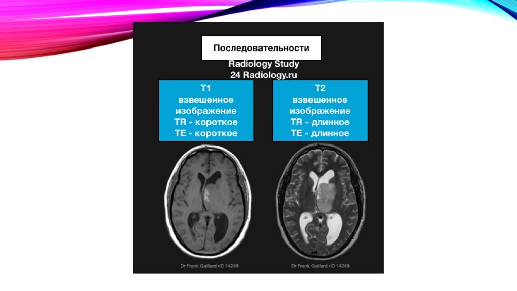 Взвешенное изображение мрт что это