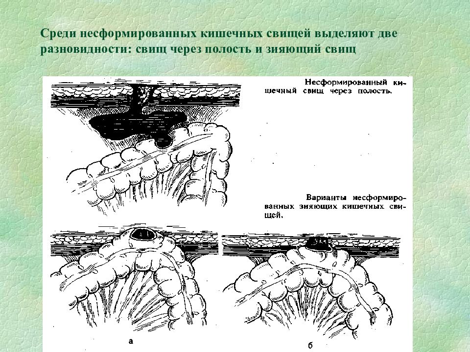 Лечение кишечных свищей