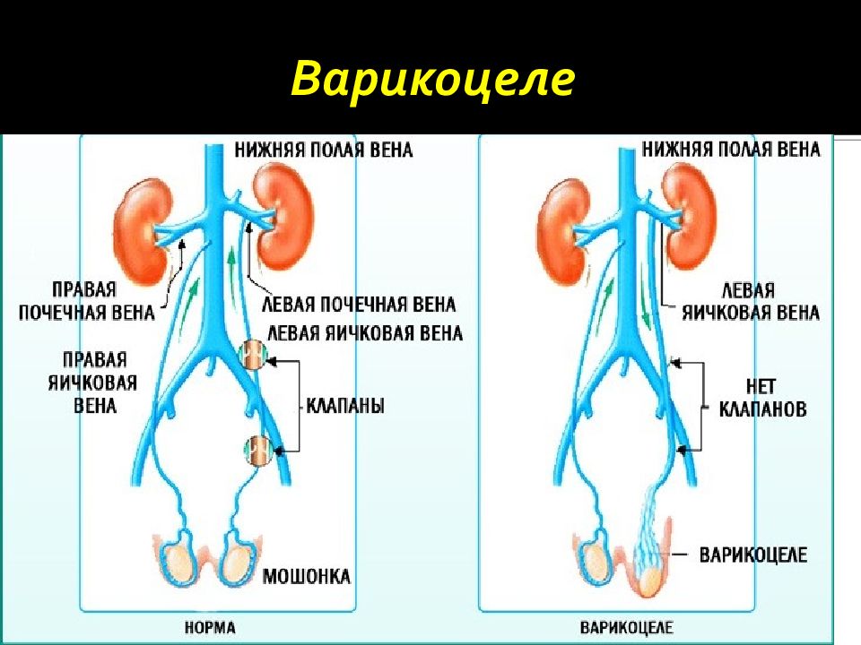 Варикоцеле профилактика