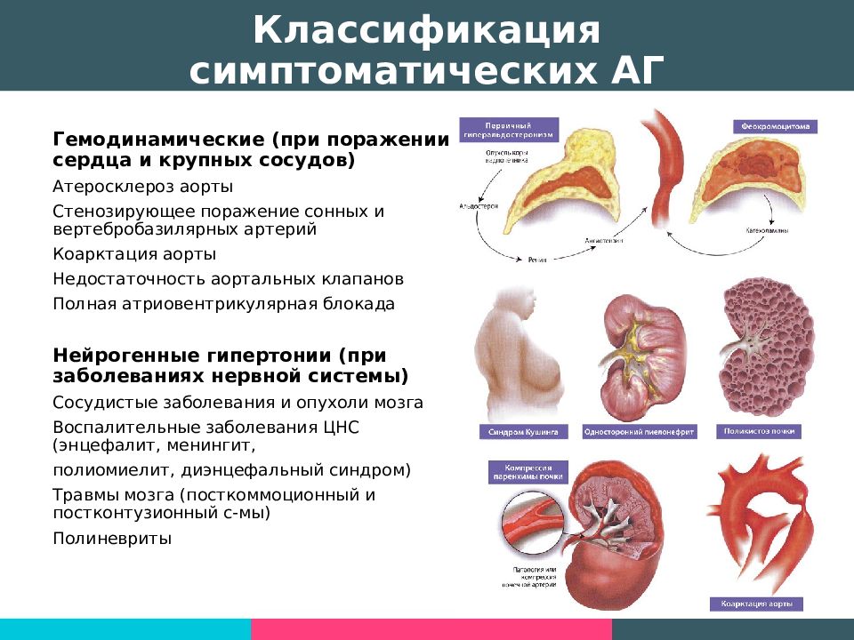 Симптоматическая артериальная гипертензия презентация