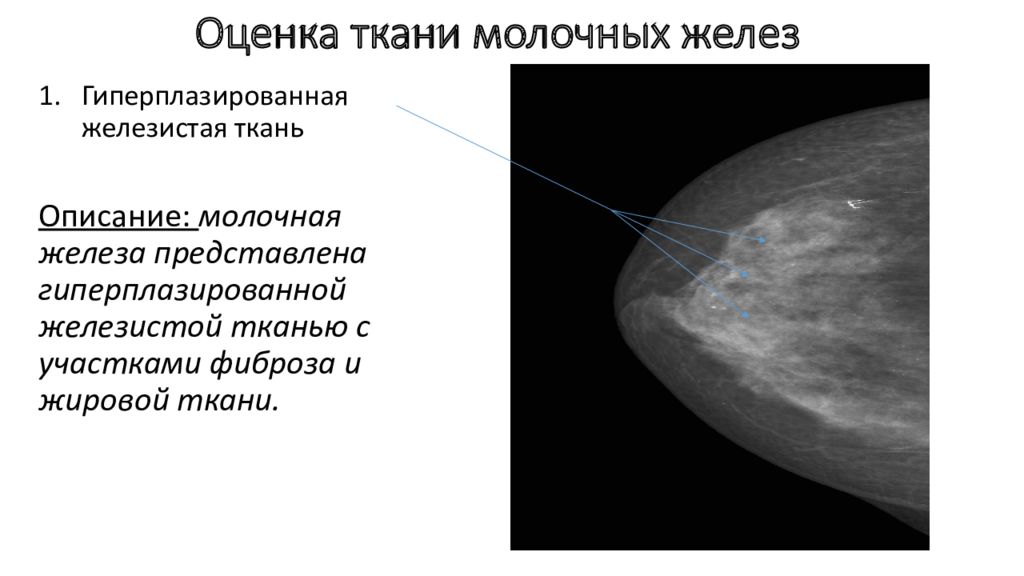Маммография уплотнения. Снимки маммографии молочных желез в норме. Фиброзно железистая мастопатия маммография. Локальный аденоз молочной железы УЗИ. Фиброзная мастопатия маммограмма.