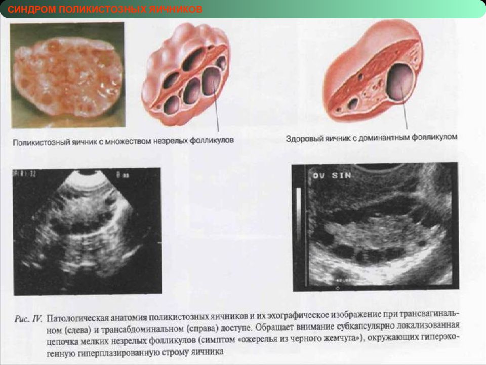 Поликистоз яичников картинки