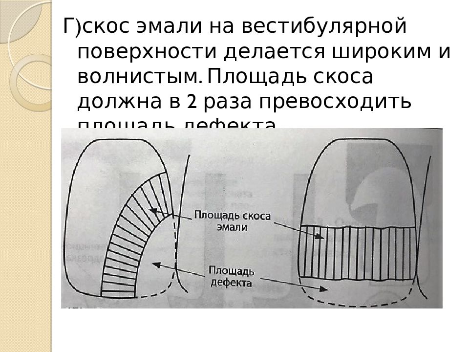 Скос. Скос эмали. Создание скоса эмали. Кариозная полость 4 класса. Препарирование кариозных полостей 4 класса.