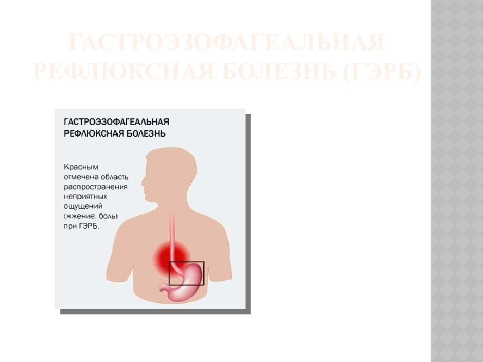 Гастроэзофагеальная болезнь. Гастроэзофагеальная рефлюксная болезнь, ахалазия кардии.. Недостаточность кардии при ГЭРБ. Гастроэзофагеальная рефлюксная болезнь. Недостаточность кардии..