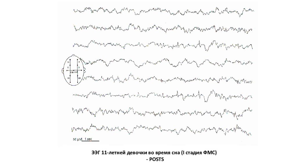 Рассмотрите рисунки изображающие электроэнцефалограммы спящего человека