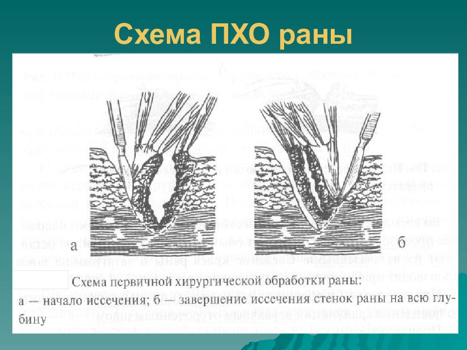 Раны обработка ран. Хирургическая обработка раны. Полная хирургическая обработка раны это. Пхо раны метод асептики.