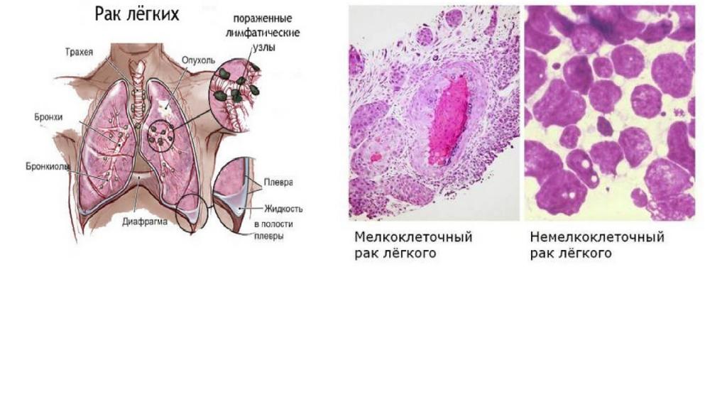 Рак легкого презентация онкология