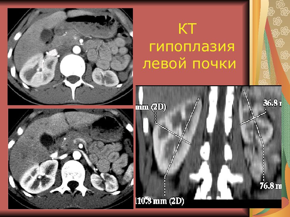 Гипоплазия почки. Гипоплазия правой почки кт. Односторонняя гипоплазия почки.