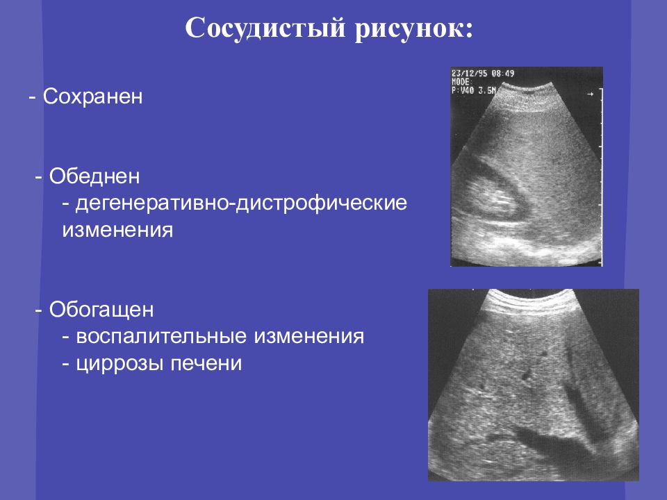 Обеднен сосудистый рисунок печени на узи