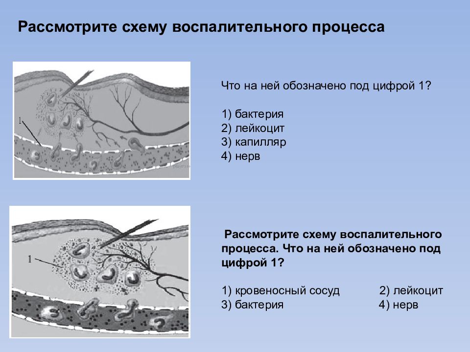Рассмотрите схему воспалительного процесса