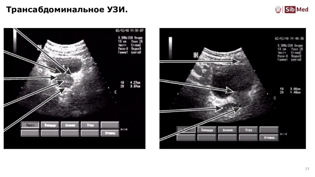 Трансабдоминальное узи