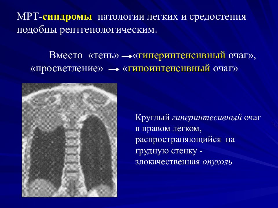 Очаг правой. Гипоинтенсивный очаг мрт. Гипоинтенсивный очаг на т2. Гипоинтенсивный очаг на т1 и т2. Гиперинтенсивный очаг мрт.