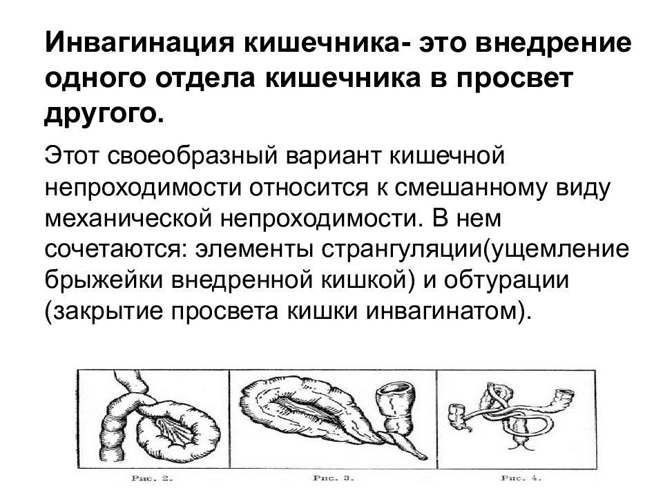 Кишечная непроходимость у детей карта вызова