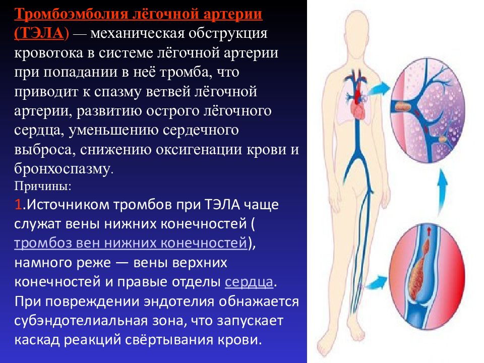 Что такое легочная тромбоэмболия простыми словами. Тромбо легочная эмболия. Тэла осложнение тромбофлебита. Профилактика тромбоэмболии легочной артерии. Тромбоэболиялегосной артерии.