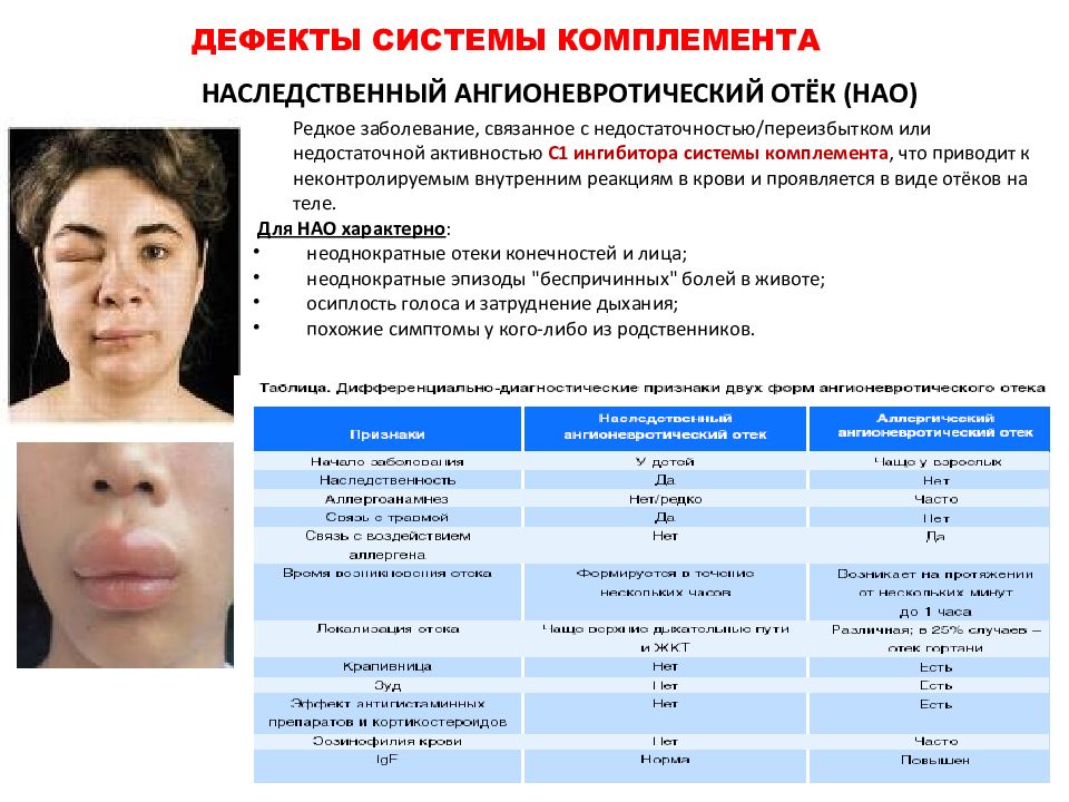 Наследственный ангионевротический отек презентация