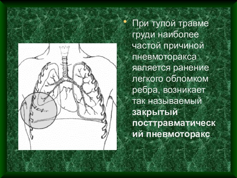 Ранение легкого. Травмы груди презентация. Проникающее ранение грудной клетки пневмоторакс. Травмы грудной клетки презентация. Основные проявления травмы груди.