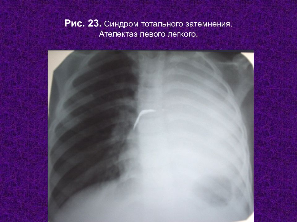 Ателектаз легкого. Тотальный ателектаз. Синдром тотального затемнения легочного поля. Рентген тотальное затемнение легкого. Обширное затемнение легочного поля.