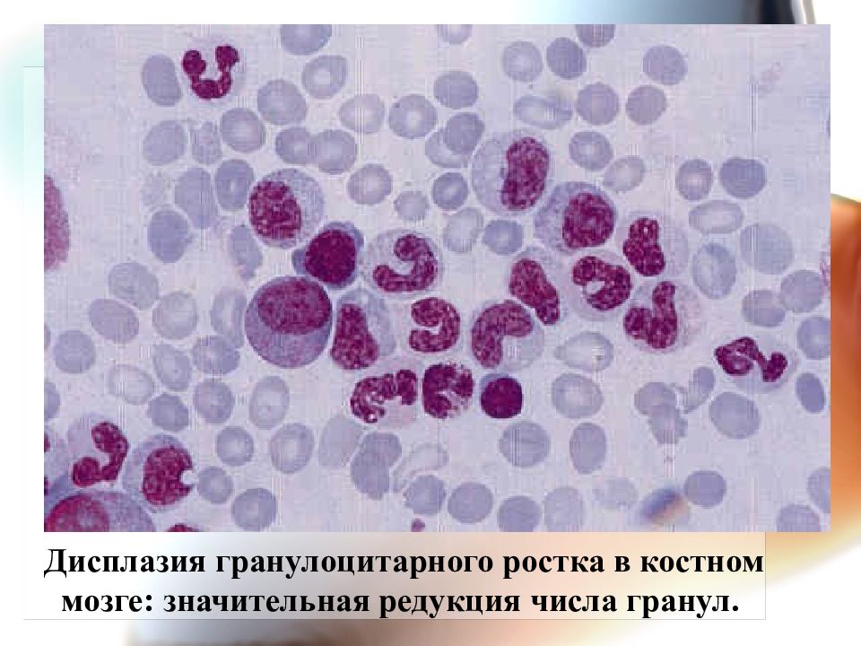 Сидеробласты. Эритрокариоциты сидеробласты. Гранулоцитарный Росток кроветворения. Сидеробласты в костном мозге. Миелодиспластический синдром промиелоциты.