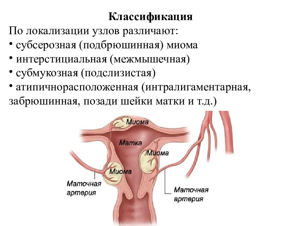 Презентация по гинекологии миома матки