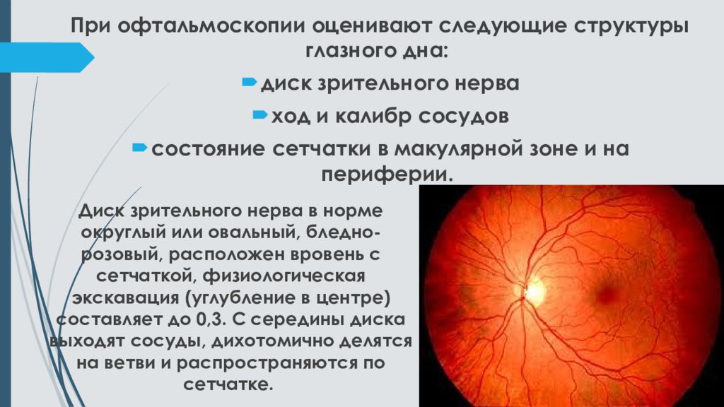 Офтальмоскопия что это. Офтальмоскопия диска зрительного нерва. Глазное дно при офтальмоскопии норма. Схема глазного дна при обратной офтальмоскопии. Метод исследования глазного дна.