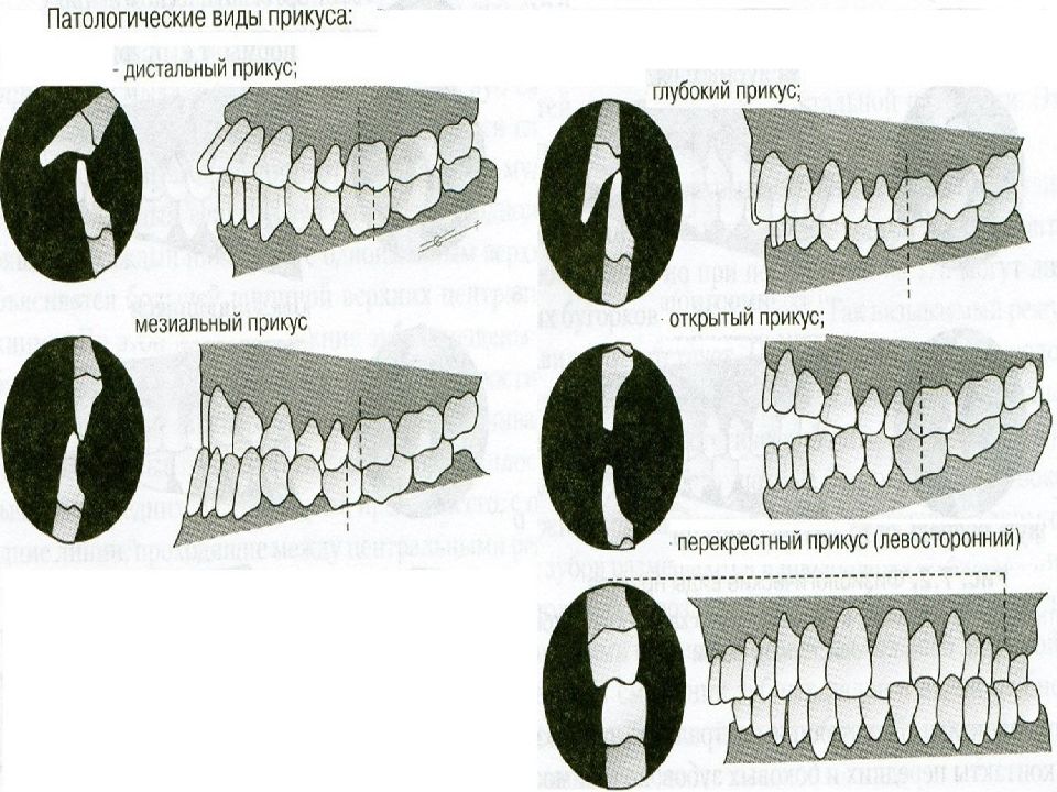 Прикус и окклюзионные контакты зубов презентация