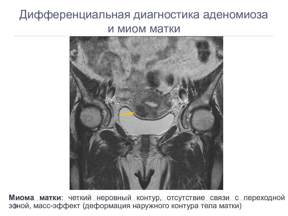 Миома и эндометриоз. Дифференциальная диагностика узлового аденомиоза. Диагностические критерии аденомиоза. Миома матки аденомиоза. Диагноз аденомиоз матки.