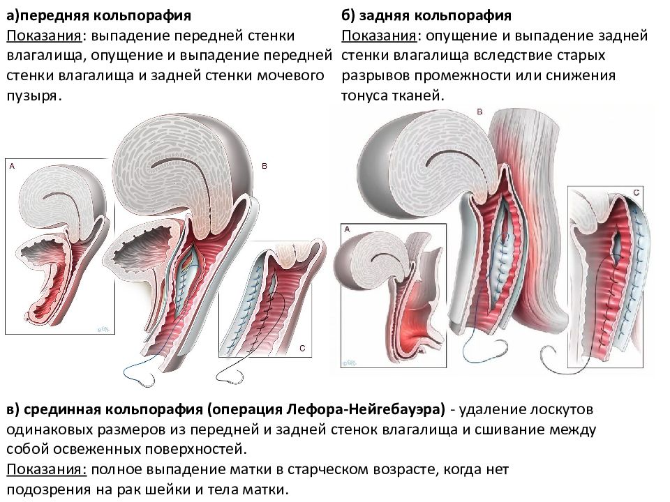 Пластика задней. Передняя и задняя кольпорафия. Передние и задние стенки влагалища.