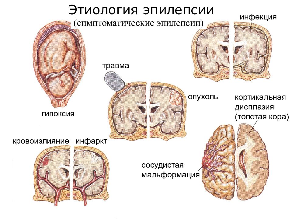 Презентация на тему эпилепсия