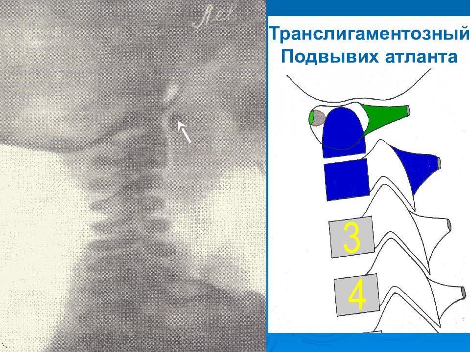 Подвывих атланта фото