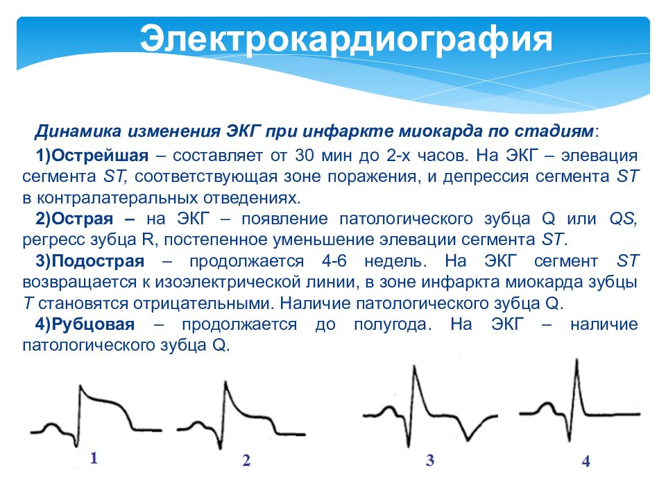 Рисунок кардиограммы сердца при инфаркте миокарда