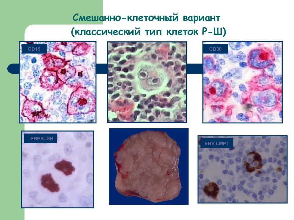 Варианты клеток. Смешанно-клеточный вариант. Классификация гемобластозов патанатомия. Осложнения гемобластозов.